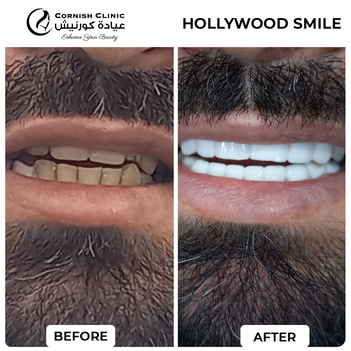 Hollywood smile before and after result from the patient