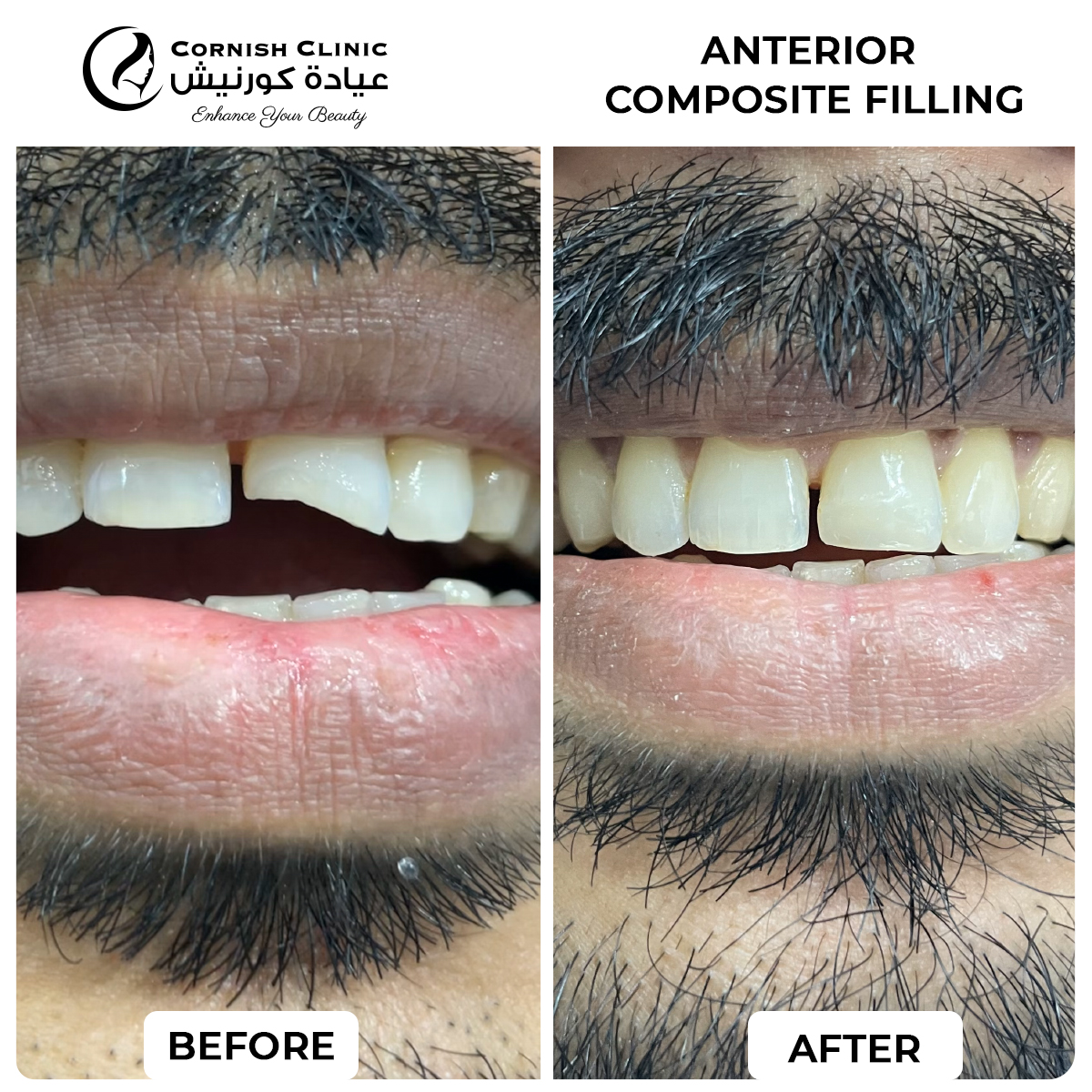 Anterior composite filling done for front tooth