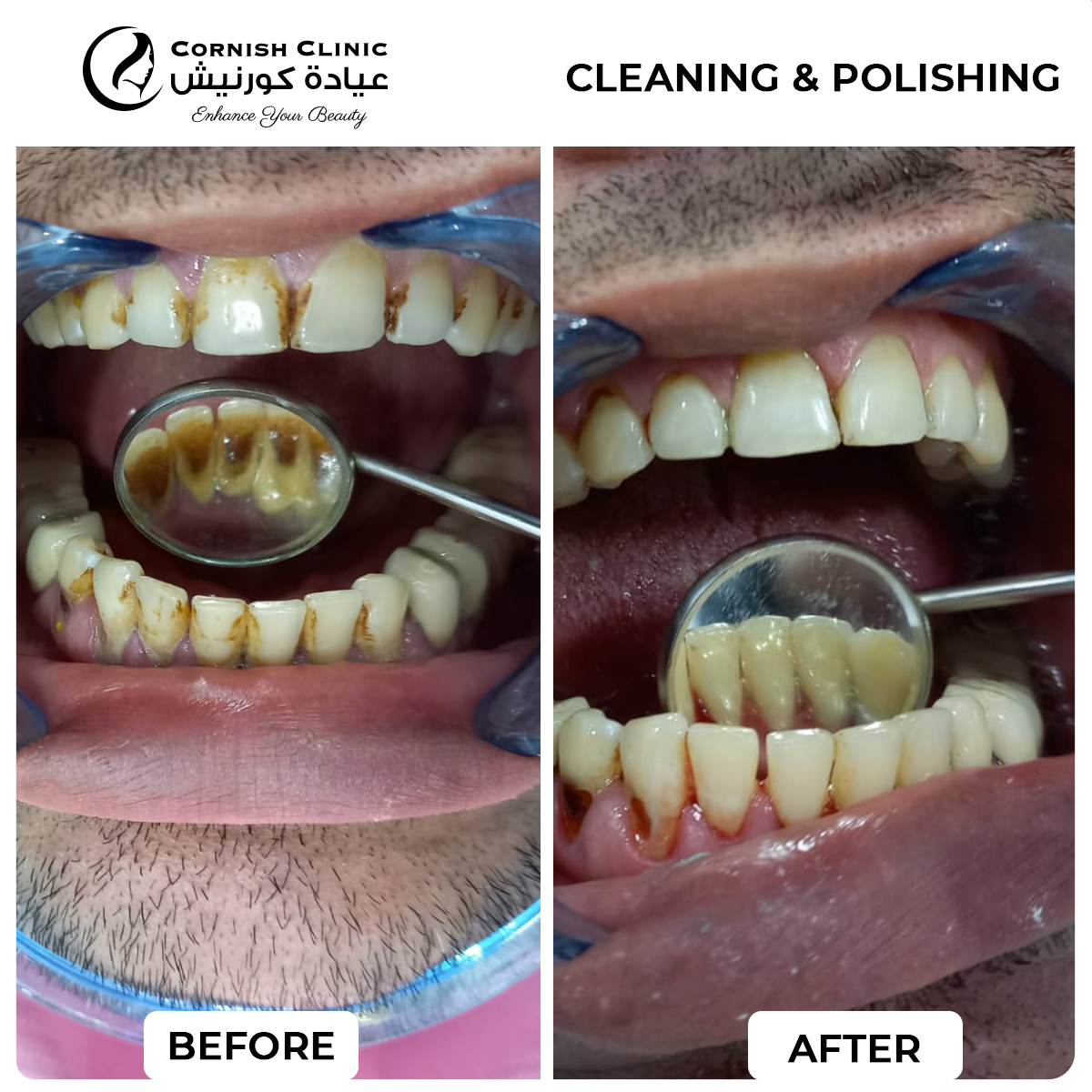 Cleaning and polishing before and after result