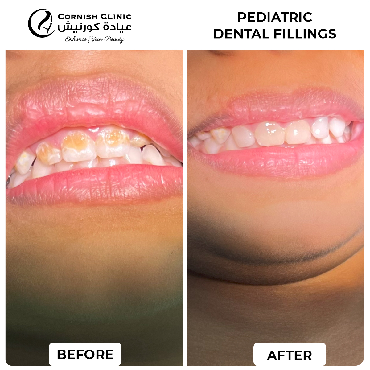 Pediatric dental filling before and after